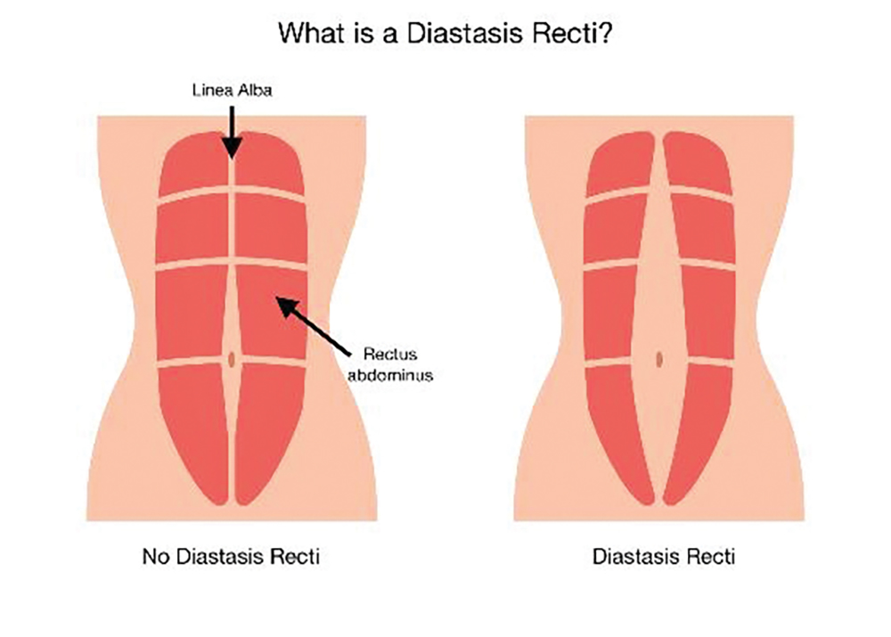 What is Diastasis Recti? - Fix Diastaisis Recti in Scottsdale AZ