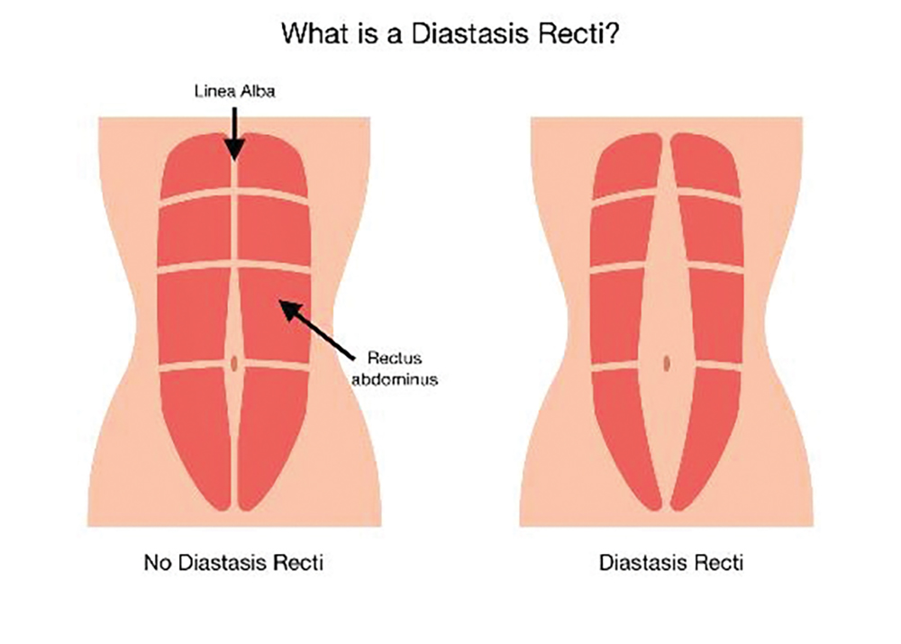 What is Diastasis Recti?